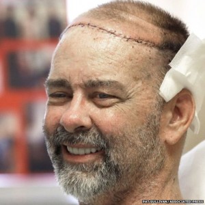 scalp-transplant