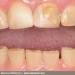 bruxism_teeth