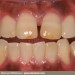 diabetic_teeth_and-_gums