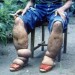 elephantiasis1